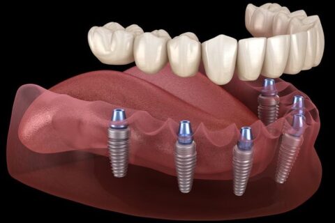 Dental İmplant