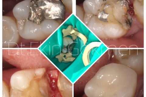 Restoratif Ve Endodonti